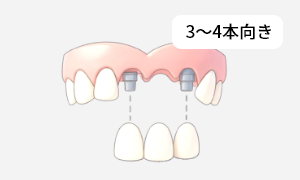 インプラントブリッジ