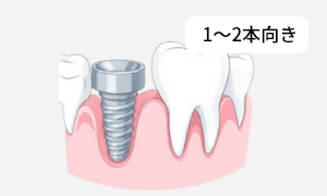 単独インプラント