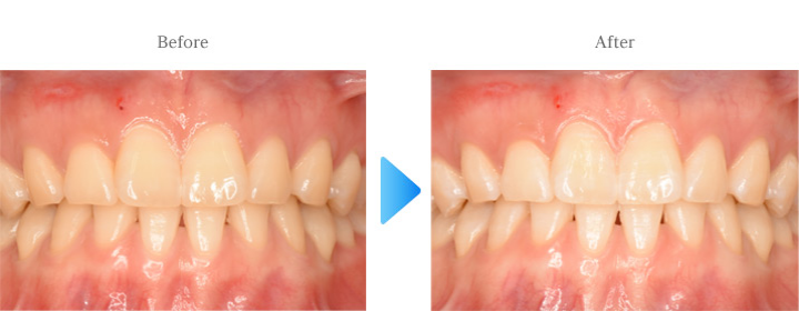 スBefore/After